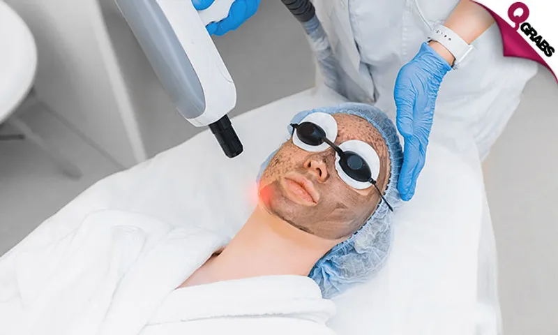 Carbon Laser Peel + Consultation for Ladies & Men!